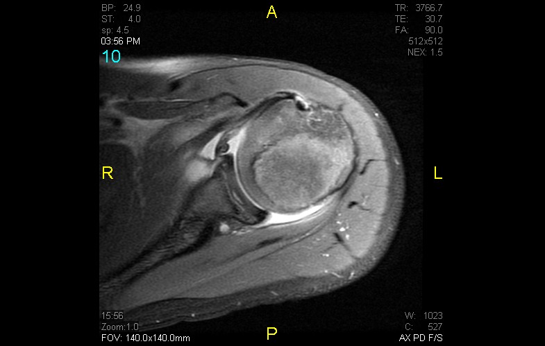 Figure 2 for case anterior shoulder dislocation